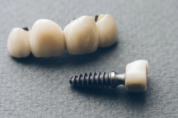 Benefits of screw retained crowns