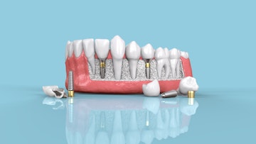 CG render of dental implants