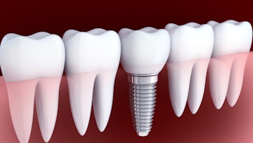 CG render of single tooth dental implant showing below screw in gumline