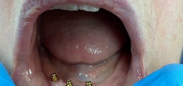 Patients mouth before receiving dental implants