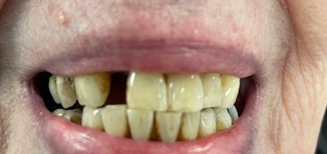 Patients smile after receiving dental implants