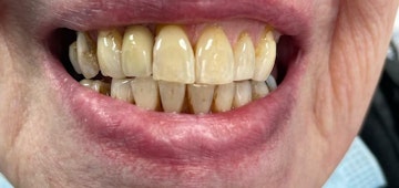 Patients smile before receiving dental implants