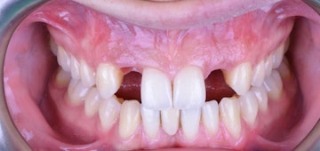 Patients smile before receiving dental implants