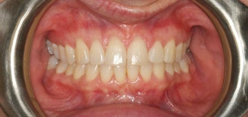 Invisalign patients teeth after treatment