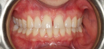 Invisalign patients teeth before treatment