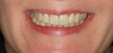 Invisalign patients smile after treatment
