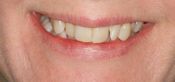 Invisalign patients teeth before treatment