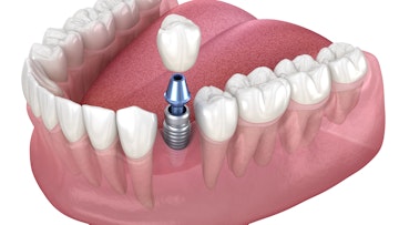 Diagram of single tooth implant